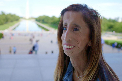 Lizzie Velasquez